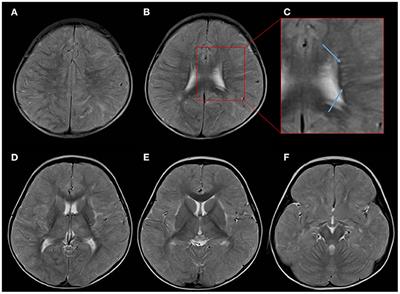 Case Report: Acute Fulminant Cerebral Edema With Perivascular Abnormalities Related to Kawasaki Disease